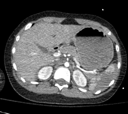 splenic laceration