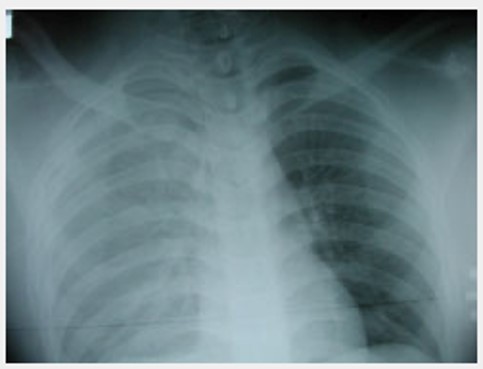 hemothorax