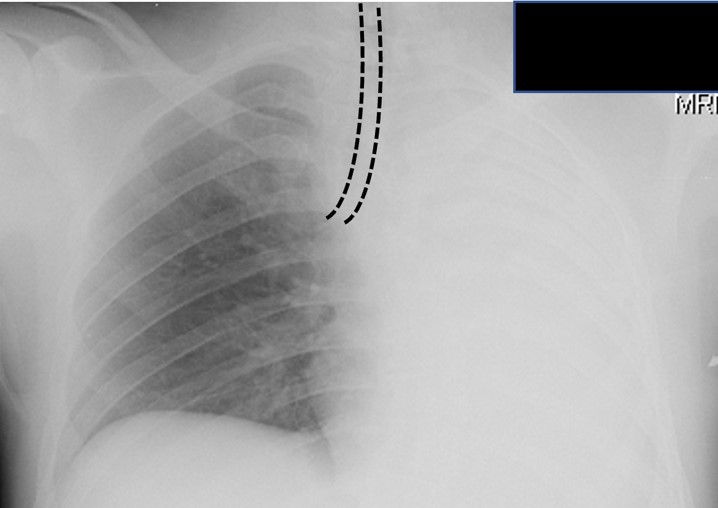 R mainstem intubation